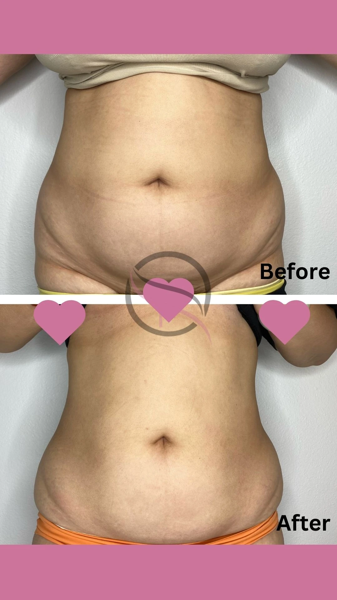 A woman 's stomach before and after liposuction.