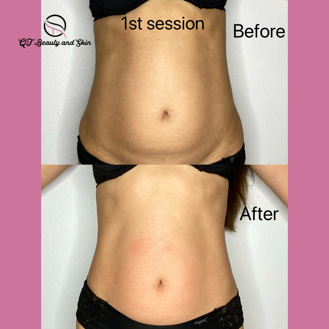 A woman 's stomach before and after her 1 st session of liposuction.