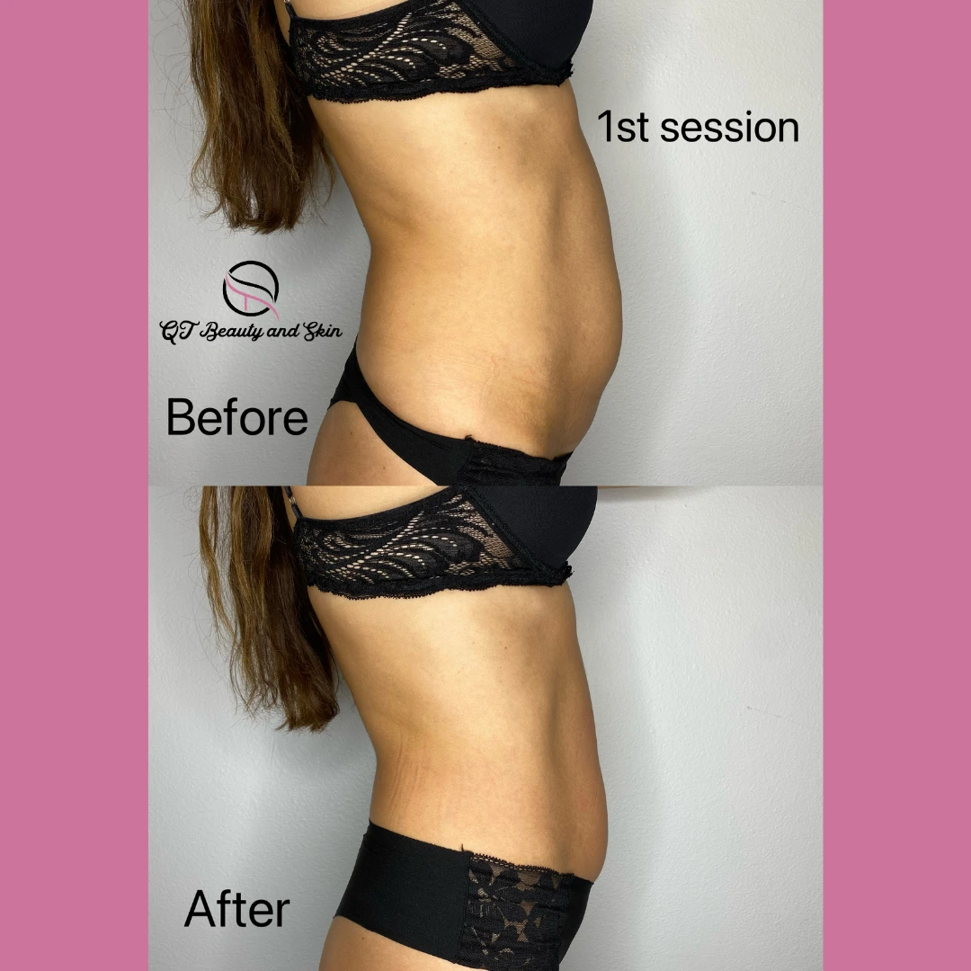 A woman 's stomach before and after her 1 st session of liposuction.