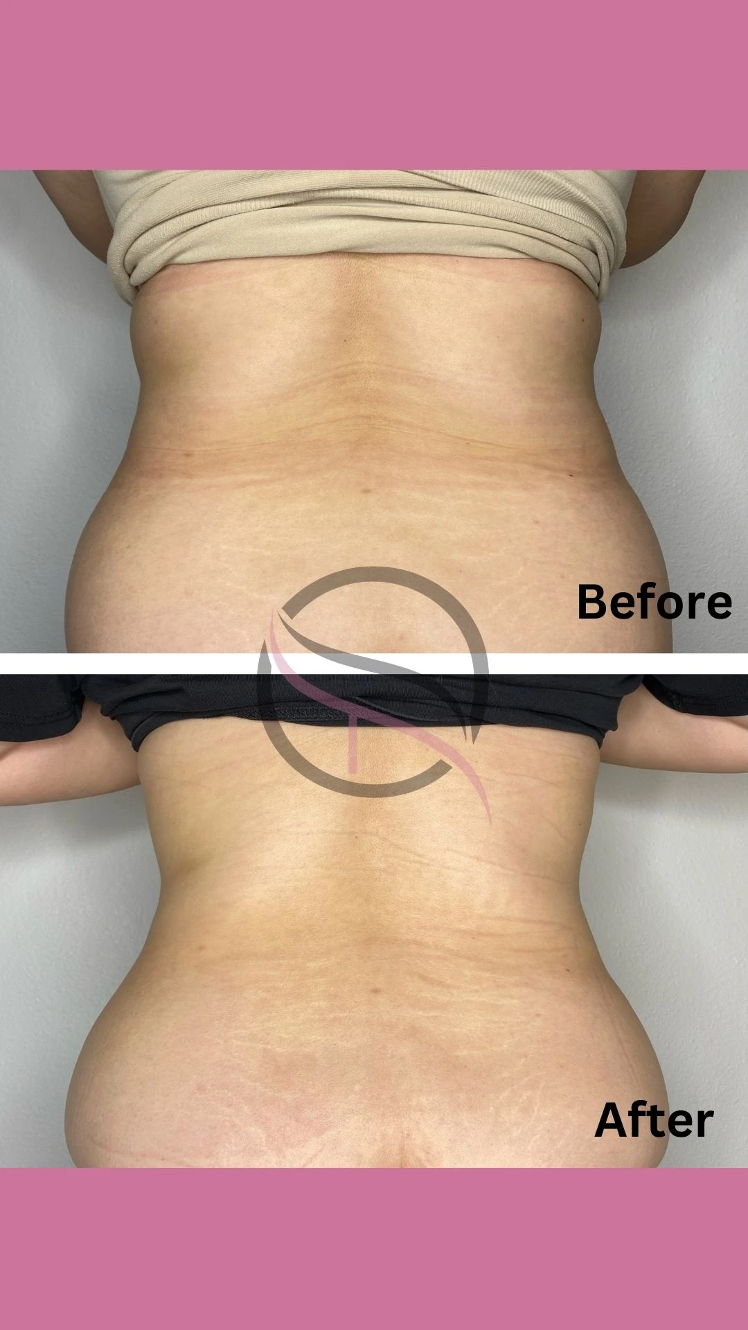 A before and after picture of the back of a woman 's body.