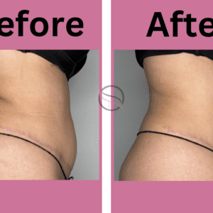 Abdominal Contouring (Slim & Tone)