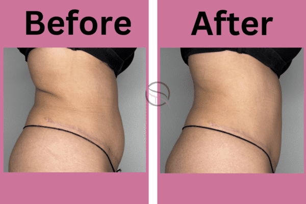 Abdominal Contouring (Slim & Tone)