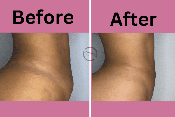 Post-Liposuction Lymphatic Drainage