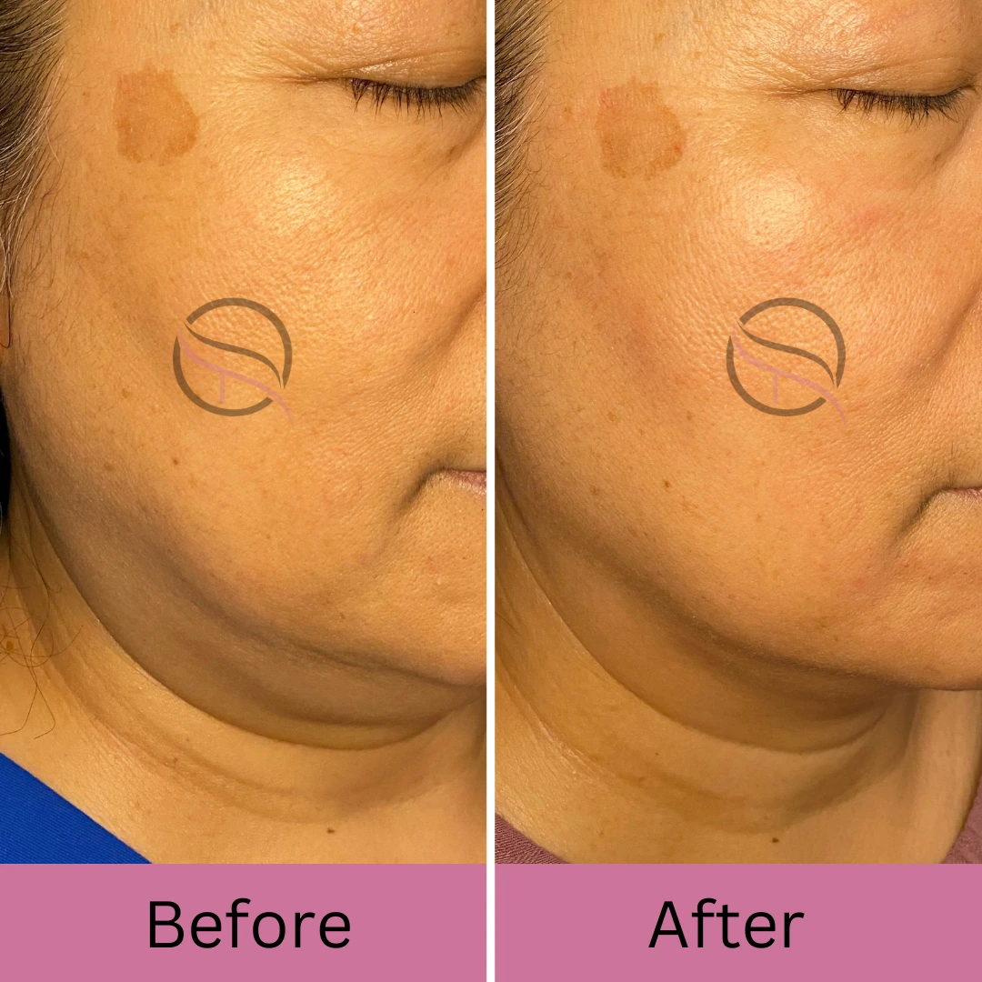 A woman 's face before and after using the light therapy.